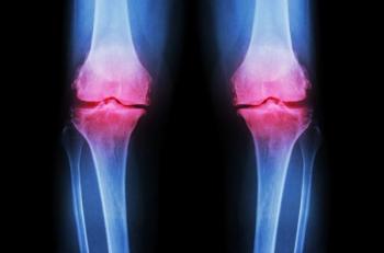 Arthritis Manifestations Differ in RA and OA Patients