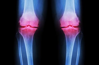 Arthritis Manifestations Differ in RA and OA Patients