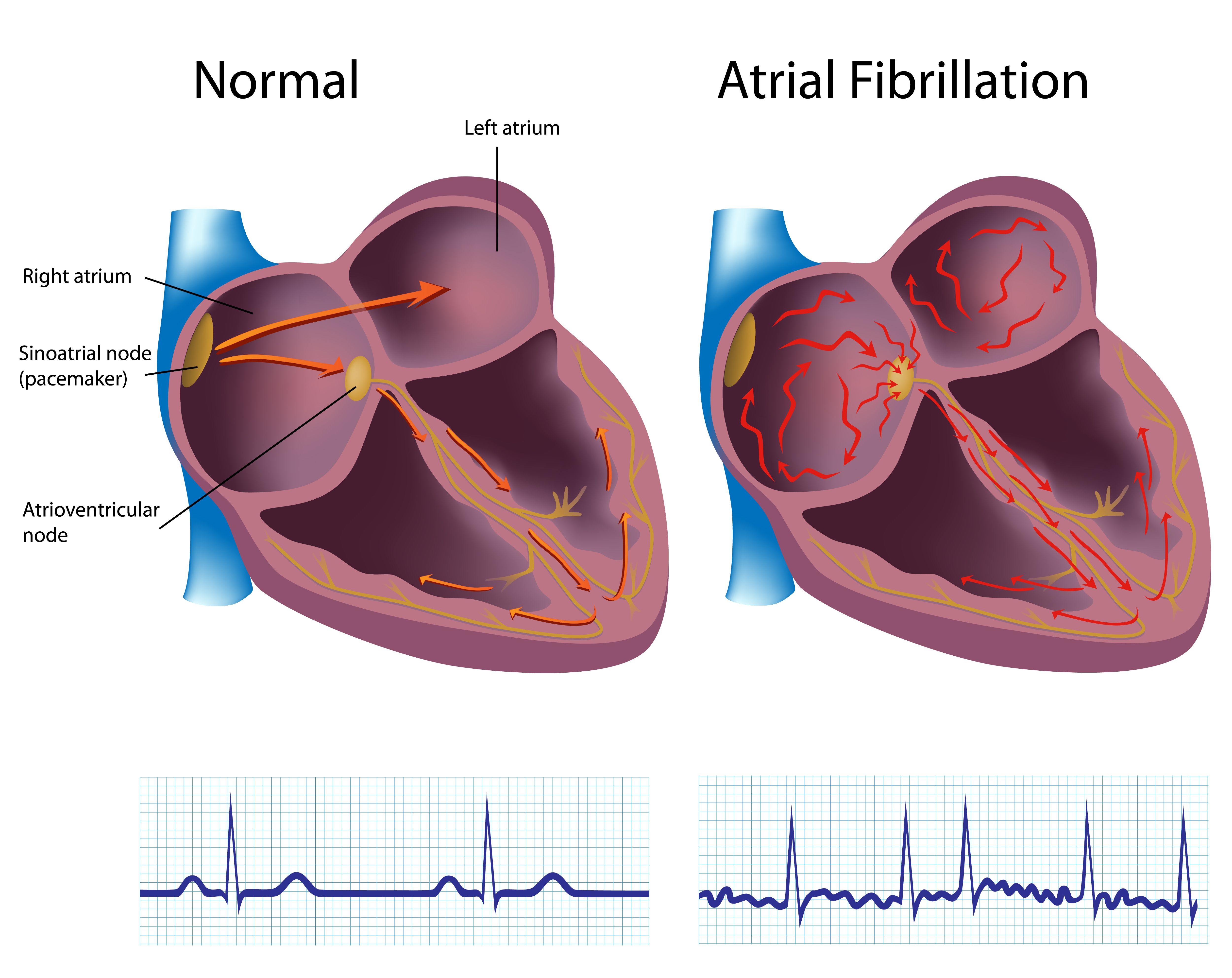 Warfarin May Heighten Risk of Osteoporosis in Afib Patients