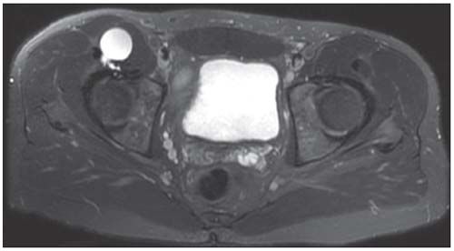 bursitis iliopsoas ct)