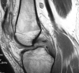 Knee Injury in a 17-Year-Old Football Player | Rheumatology Network