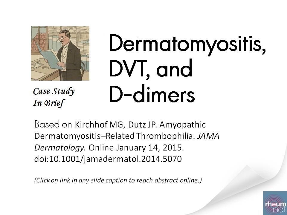 amyopathic dermatomyositis