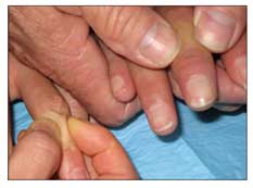 systemic scleroderma hands