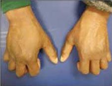 Bilateral Hand Swelling: Clue to What Condition? Rheumatology Network
