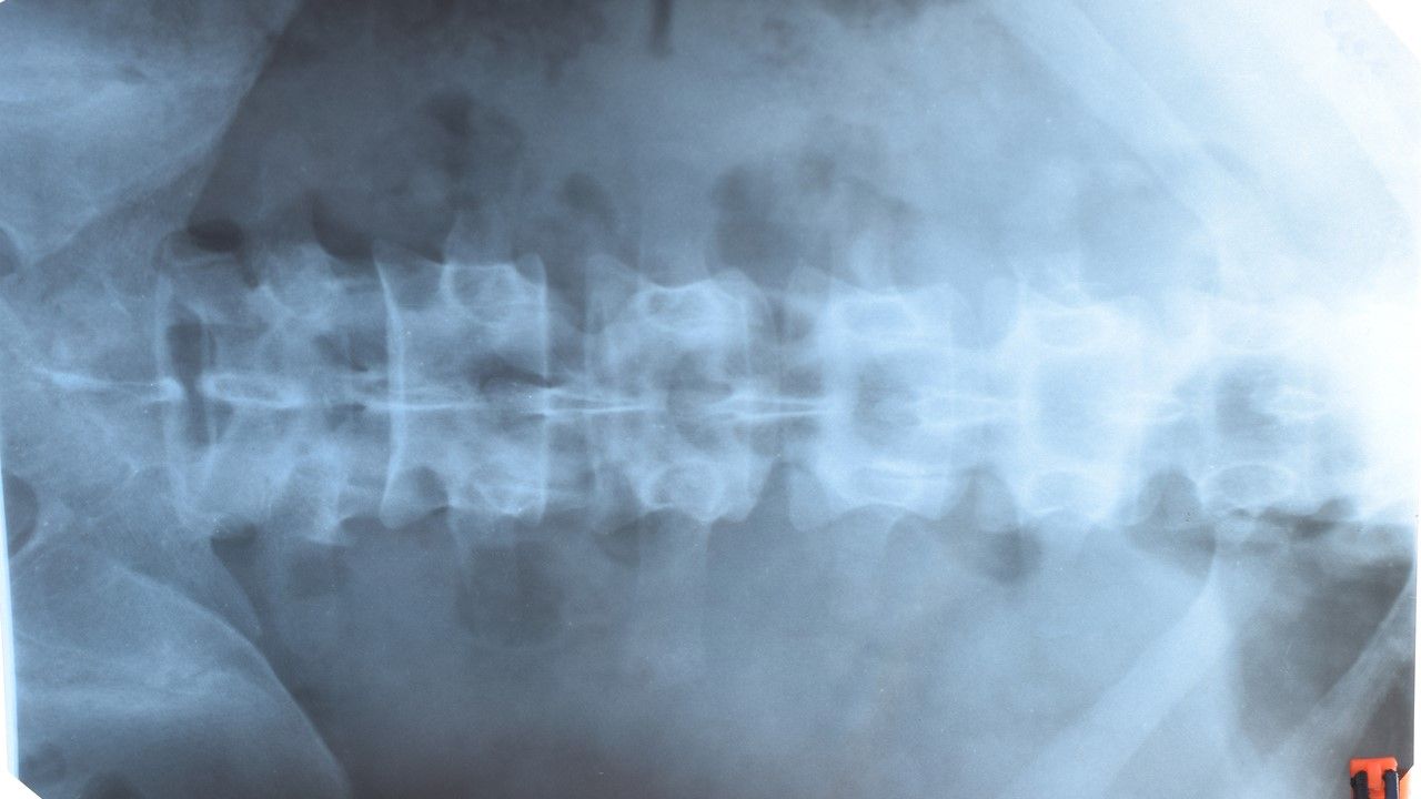 Recognizing Axial Spondyloarthritis in Primary Care