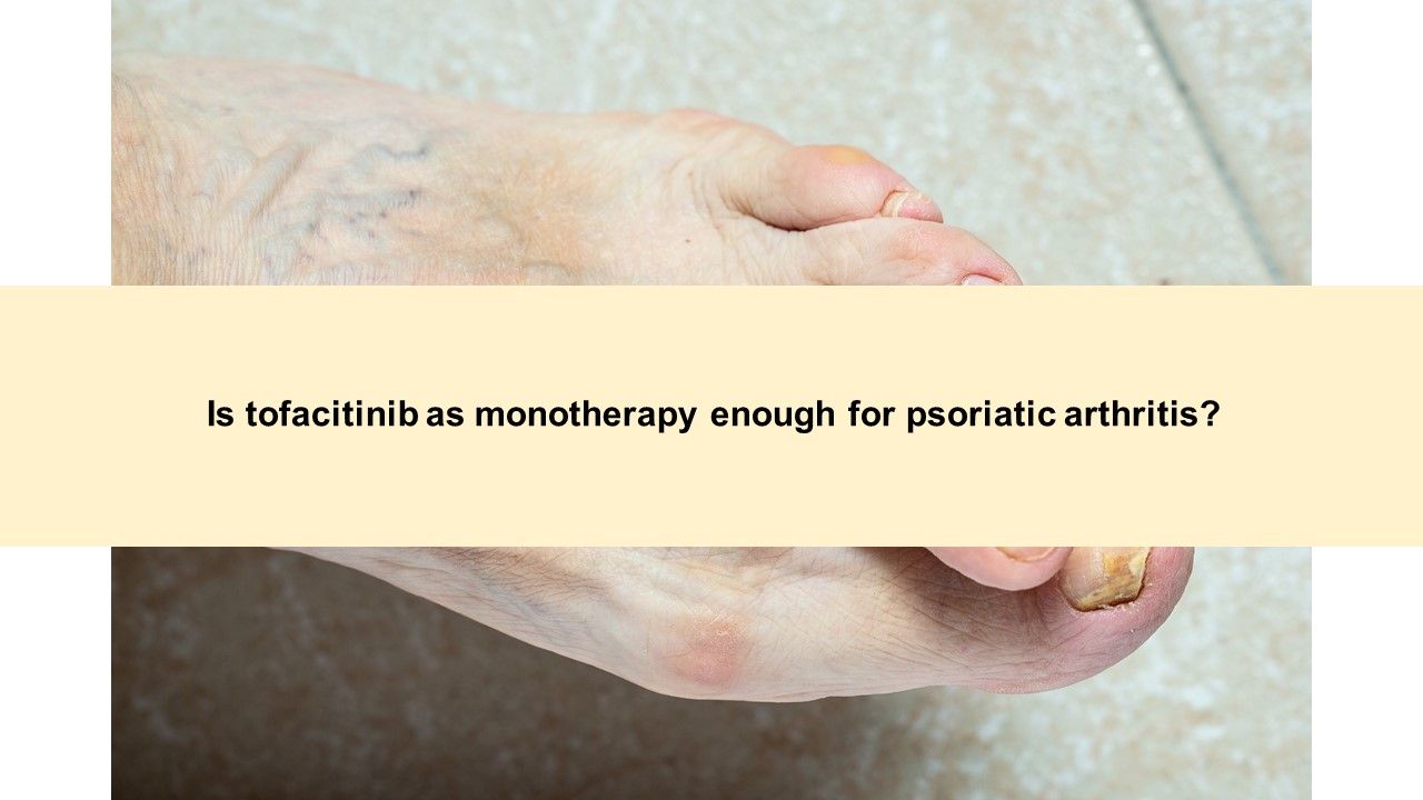 Psoriatic Arthritis Quiz: Monotherapy, Complimentary Medicine and Joint Destruct