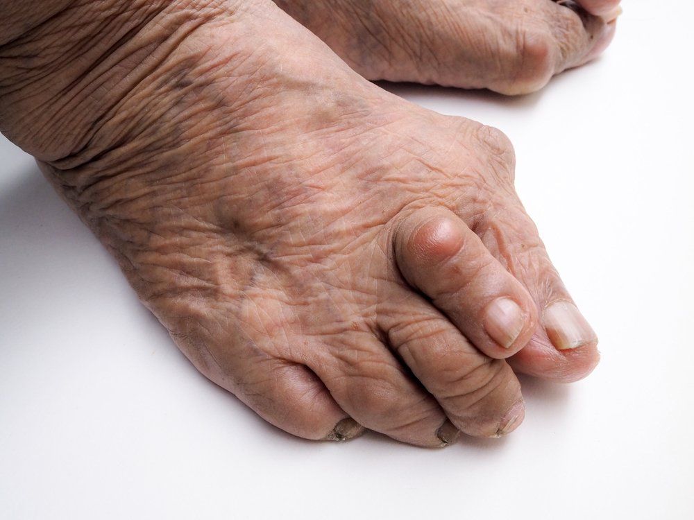 Gout symptoms foot picture image