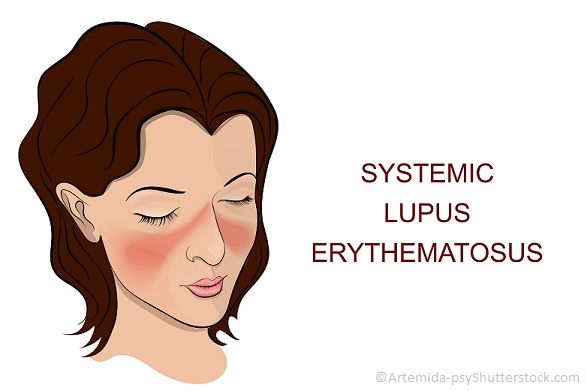 FATIGUE IN LUPUS IS REAL