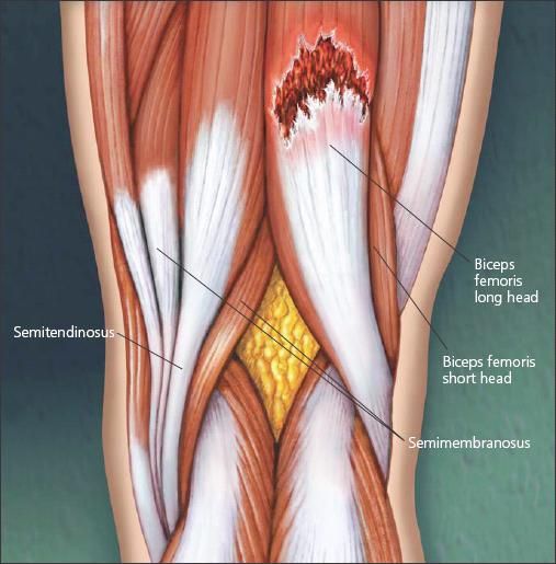Clinical Management Of Muscle Strains And Tears