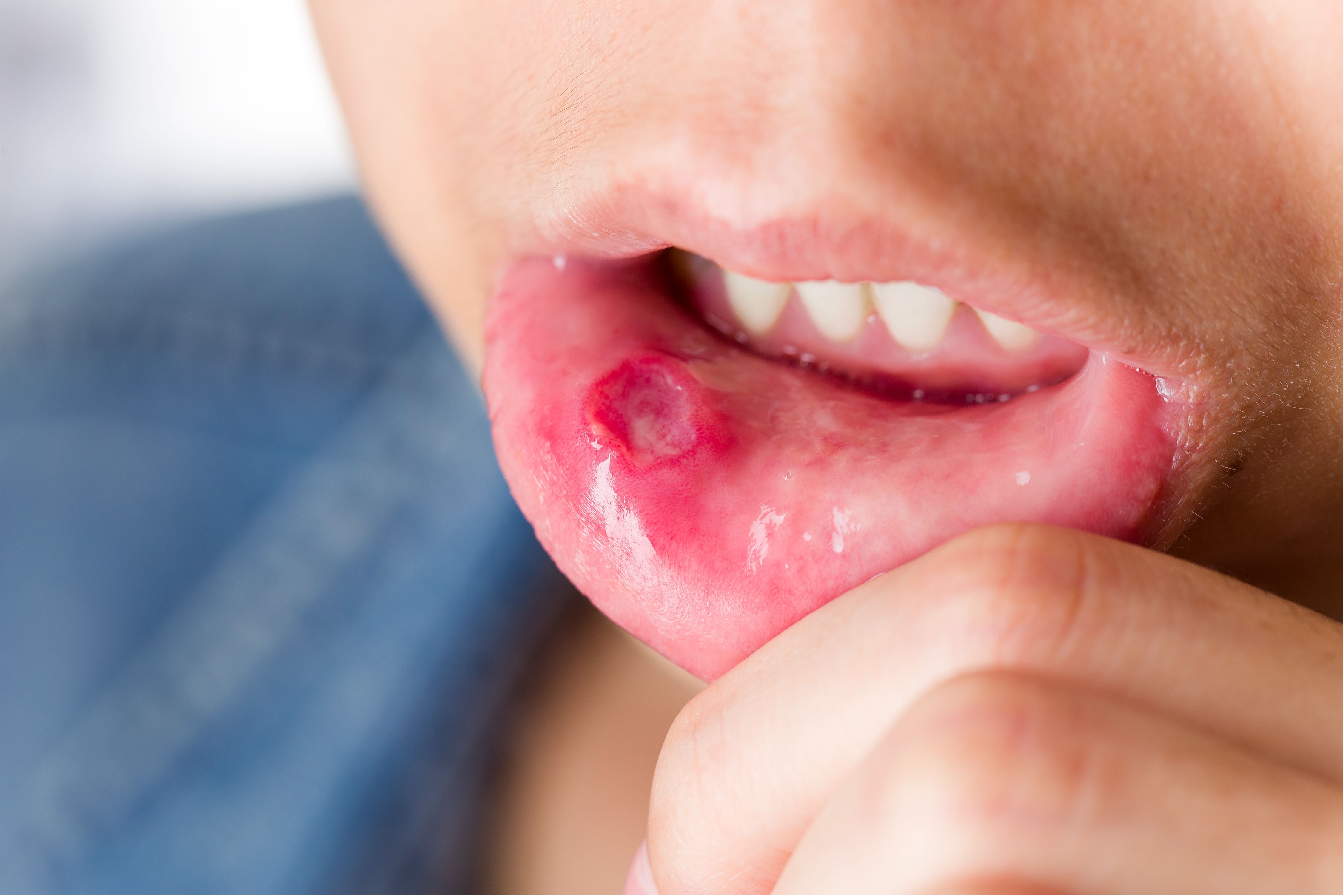 Apremilast Reduces Oral Ulcers In Behcet S Syndrome Apremilast Reduces Oral Ulcers In Behcet S Syndrome