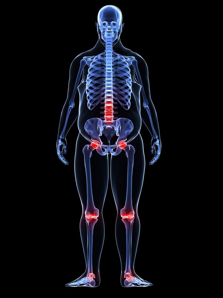 A Singular Rise for Arthritis and Obesity