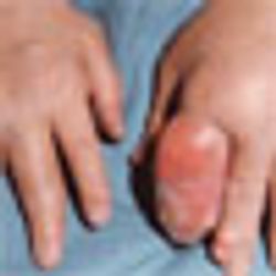 Addressing problems in gout and hyperuricemia