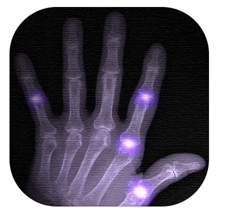 DAS28 Calculator (©Rheumatology LMU)