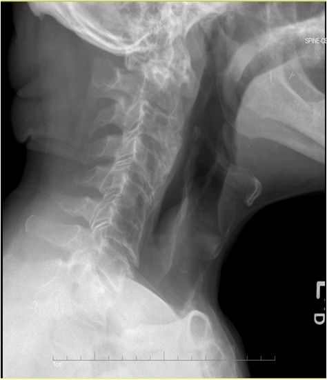 82-Year-Old Man With Gout, Hypertension, Dizziness, and Neck Pain