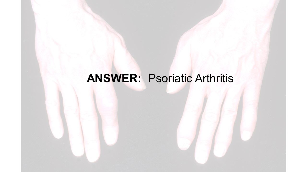 Psoriatic Arthrits Quiz:  Phenotypes