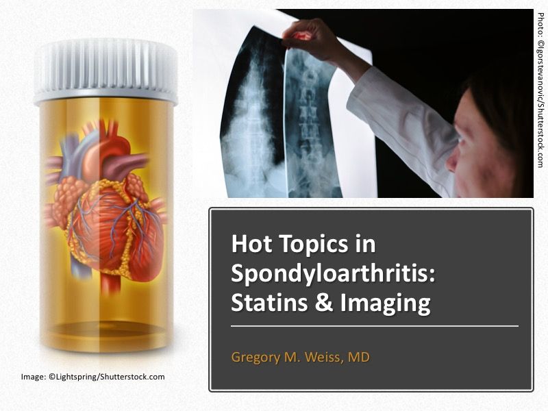 Hot Topics In Spondyloarthritis Statins Imaging Rheumatology Network
