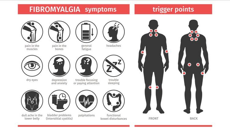 Intramuscular Pressure Linked to Pain in Fibromyalgia