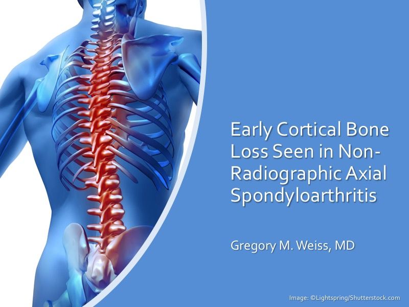 Early Cortical Bone Loss Seen in NonRadiographic Axial