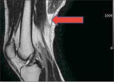 biceps femoris tendon mri