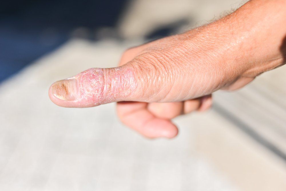 Beyond the "Oil Drop Sign" in Nail Psoriasis