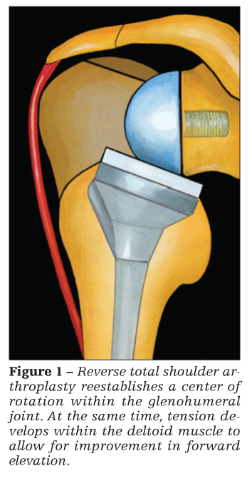Current Issues in Reverse Total Shoulder Arthroplasty Current Issues in Reverse Total Shoulder Arthroplasty