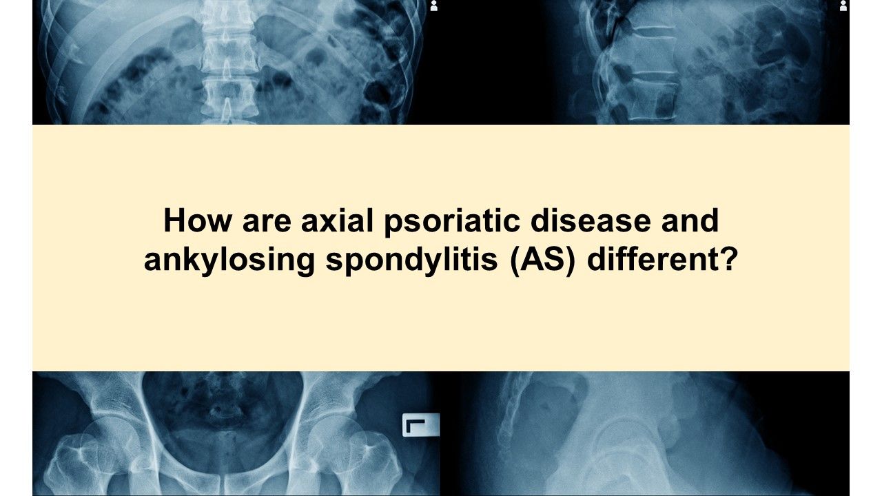 Psoriatic Arthritis Health Quiz Is it axial PsA or AS? Rheumatology