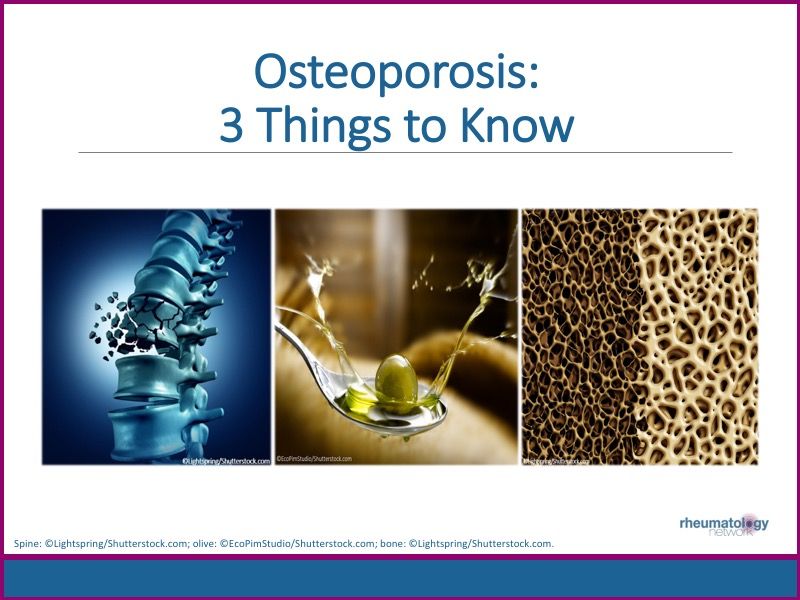 Osteoporosis 3 Things to Know Rheumatology Network