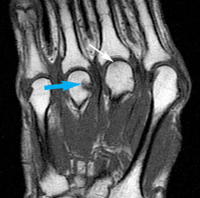 Baseline Bone Erosions Are Prognostic Signs in RA | Rheumatology Network