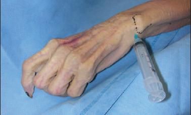 wrist injection