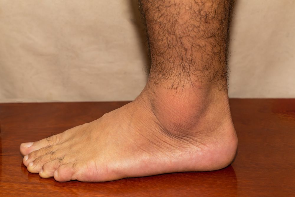 Gout Flares Persist, Despite Effective Treatments