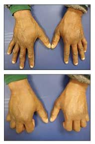 Evaluating Edema Of The Hands