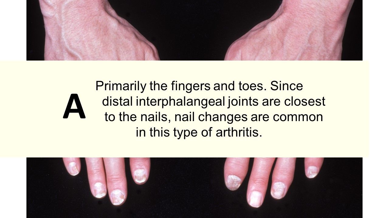 Psoriatic Arthritis Quiz: What are the five forms of PsA ...