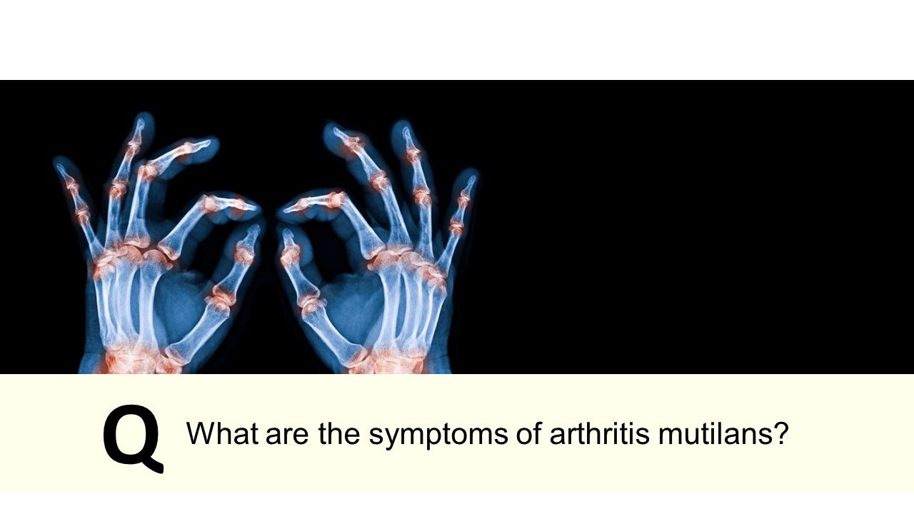 Psoriatic Arthritis Quiz What are the five forms of PsA?