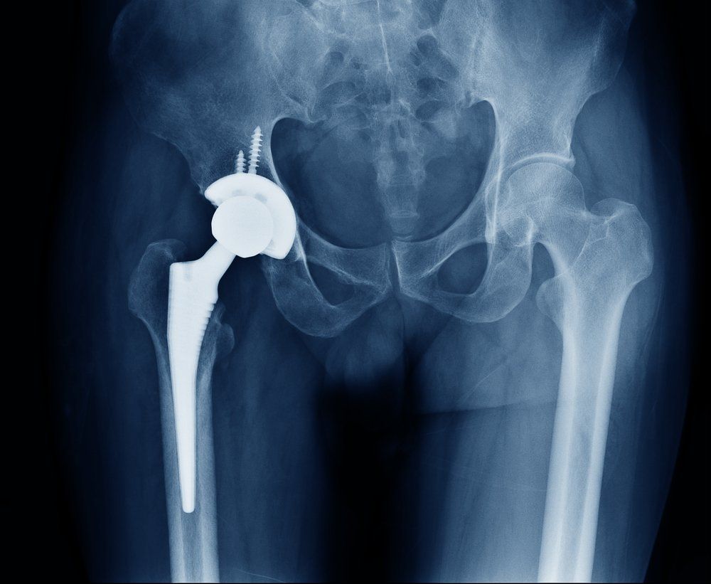 Total Hip Arthroplasty No Better Than Partial Joint Replacement ...