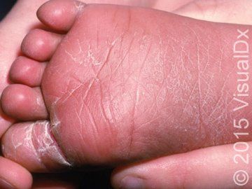 Image Iq Infant With Skin Peeling Image Iq Infant With Skin Peeling