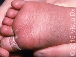 Image IQ: Infant with skin peeling