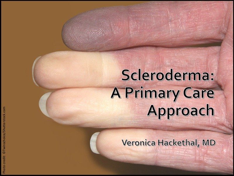 Scleroderma: a primary care approach