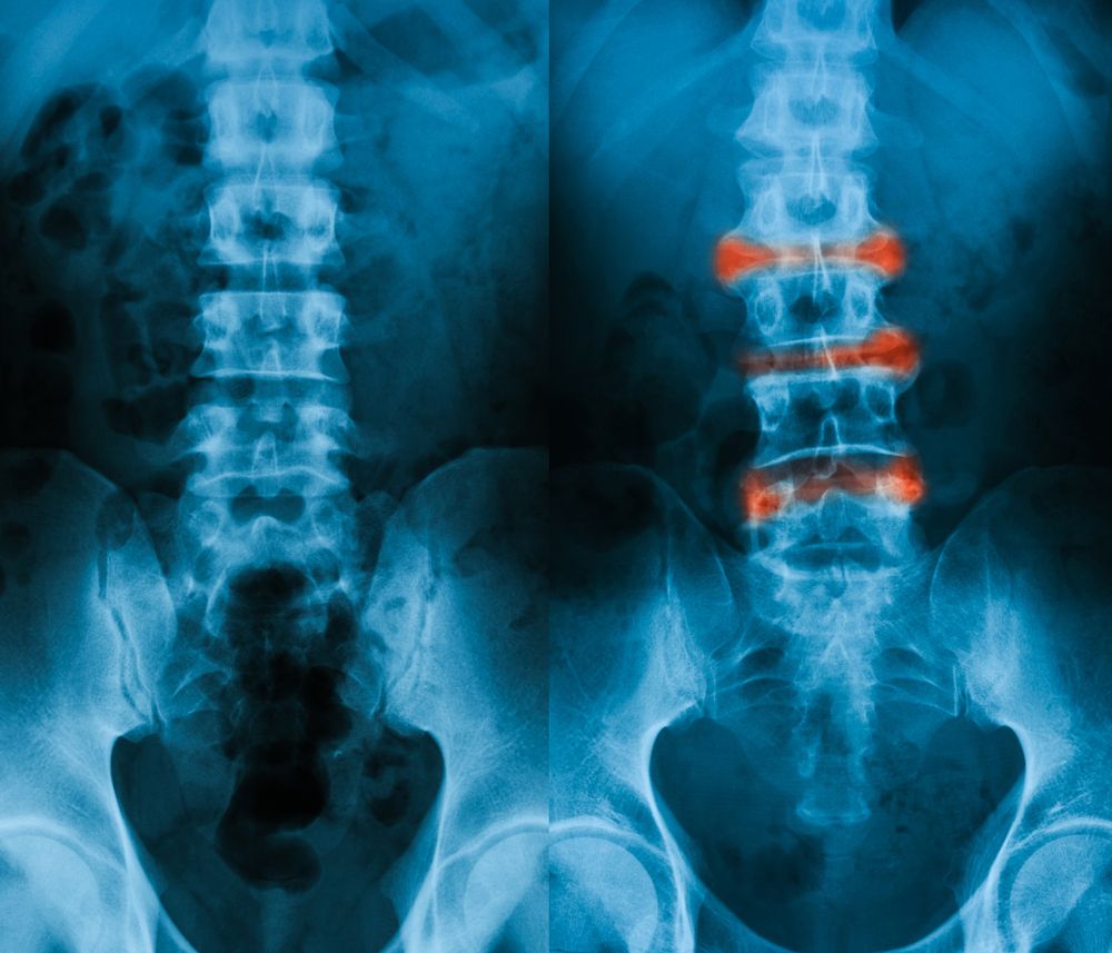 Ankylosing spondylitis spine 