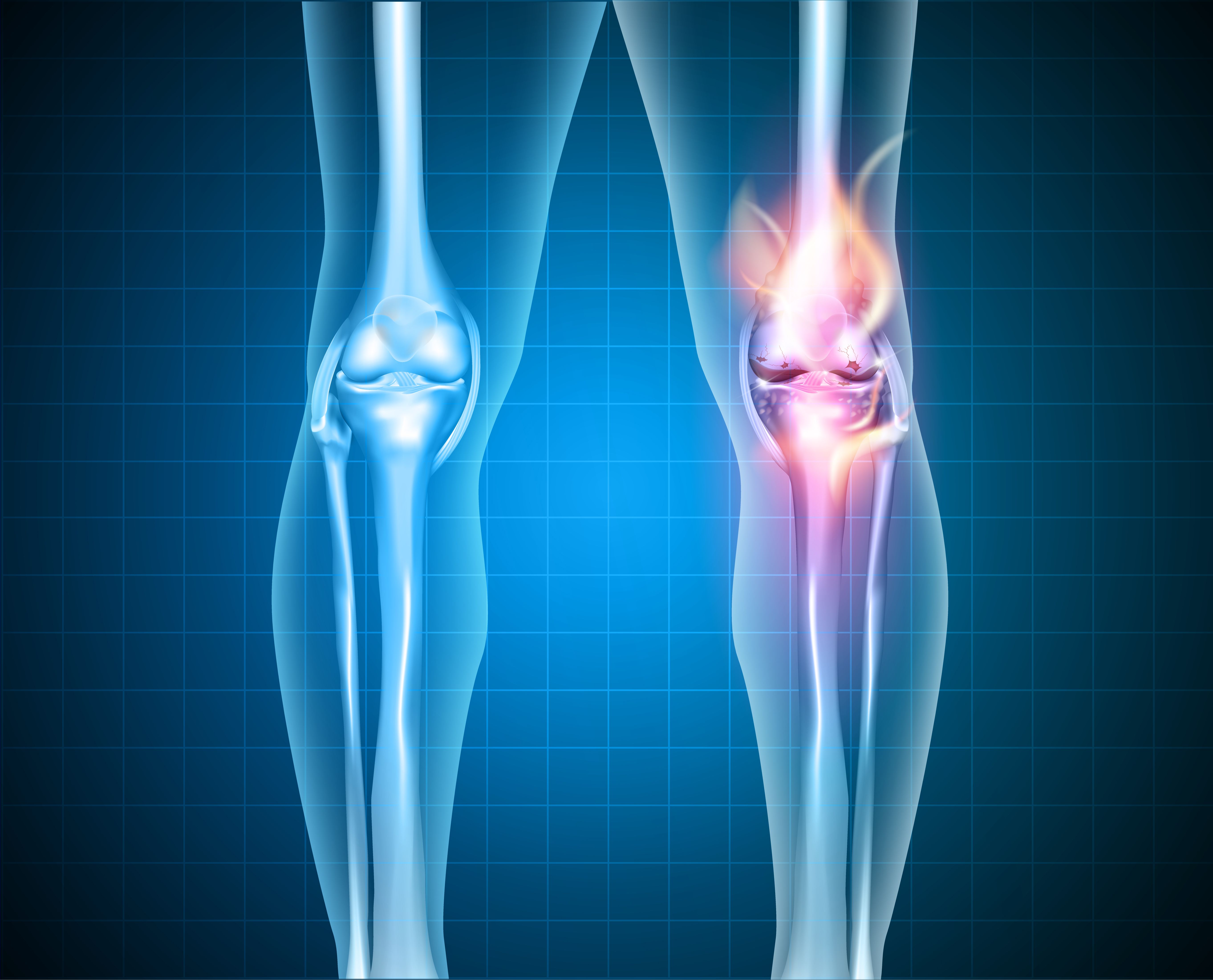 LowDose Radiation Therapy for Knee, Hand Osteoarthritis