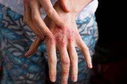 Apremilast Safely Treats Patients with Psoriasis, Psoriatic Arthritis in Real-World Setting