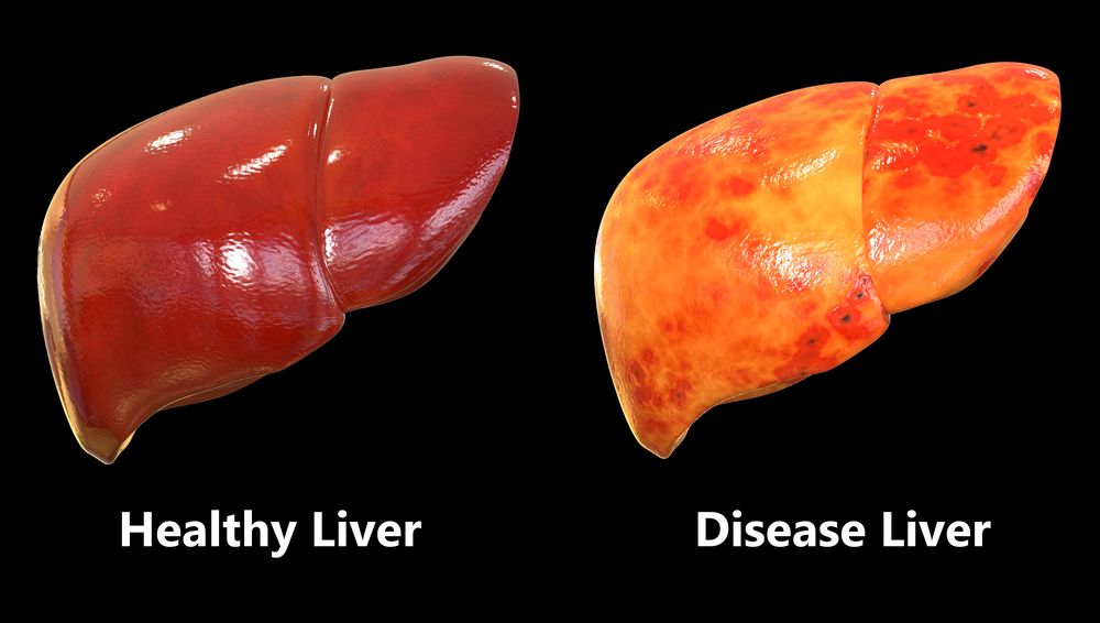 Fatty livery disease (©MagicMine/Shutterstock.com)