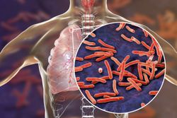Secukinumab Not Associated With Tuberculosis