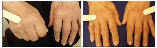 Evaluating Edema Of The Hands