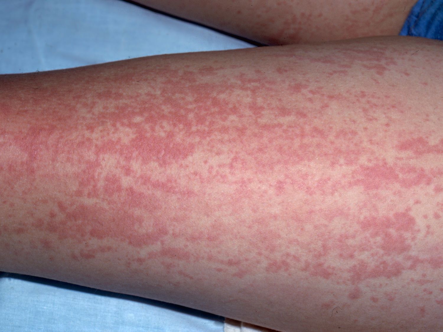 Image Iq Erythematous Rash Image Iq Erythematous Rash
