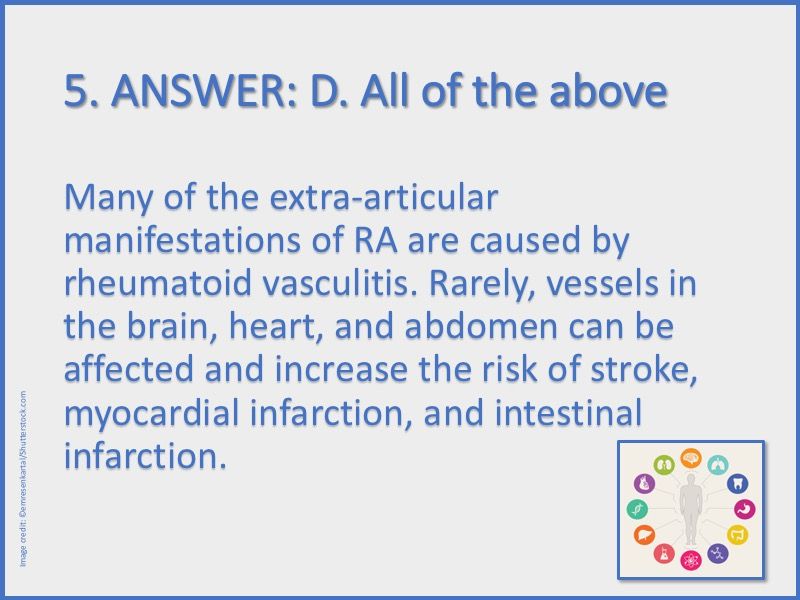 Extraarticular Manifestations of RA A Quiz Rheumatology Network