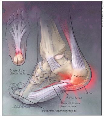 heel pain that radiates to ankle
