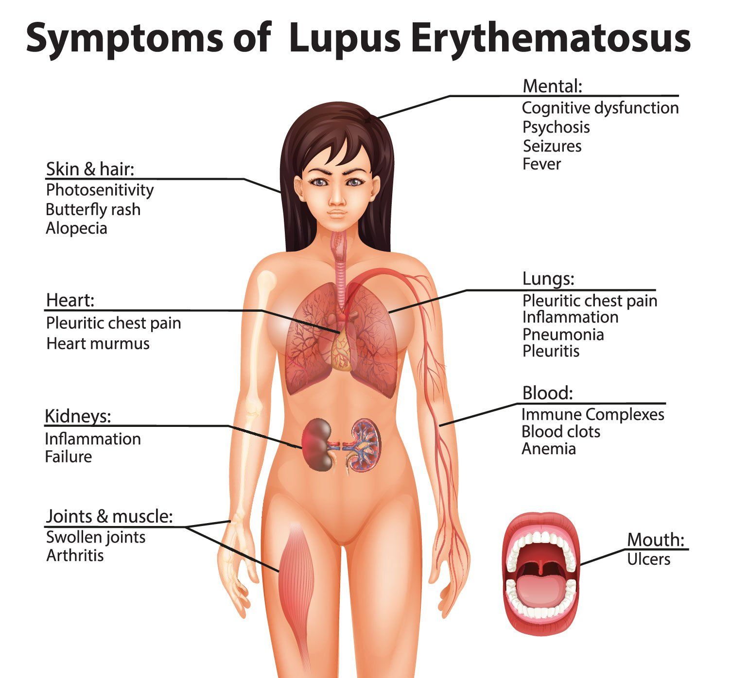 Symptoms lupus