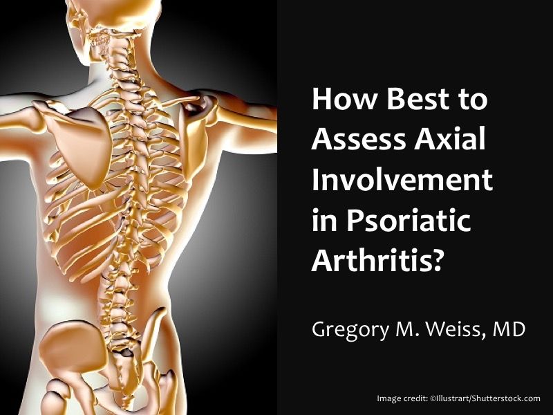 How Best to Assess Axial Involvement in Psoriatic Arthritis