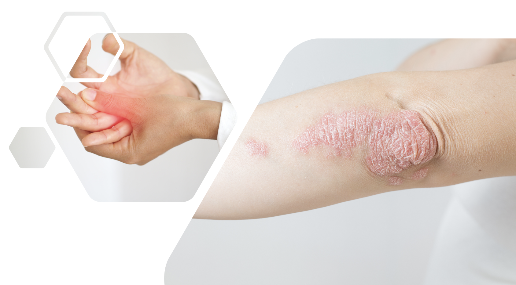 Guselkumab Effective In Treating Enthesitis In Psoriatic Arthritis