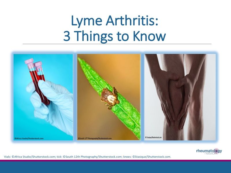Lyme Arthritis 3 Things to Know Rheumatology Network